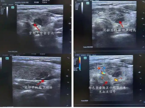 甲状腺超声图像分析软件SW-TH01/II